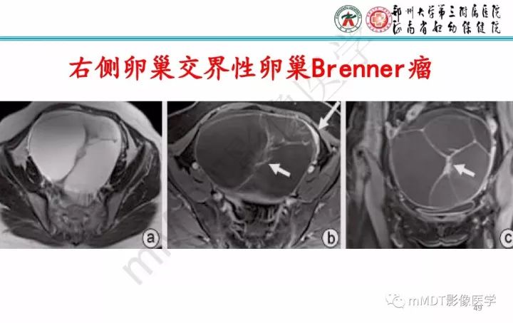 【PPT】卵巢肿瘤的影像诊断思路