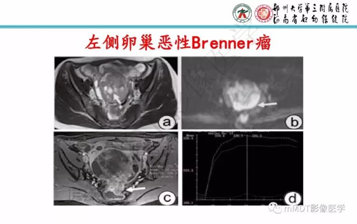 【PPT】卵巢肿瘤的影像诊断思路