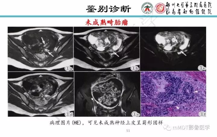 【PPT】卵巢肿瘤的影像诊断思路