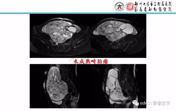 【PPT】卵巢肿瘤的影像诊断思路