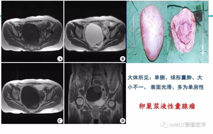 【PPT】卵巢肿瘤的影像诊断思路