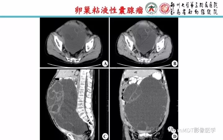 【PPT】卵巢肿瘤的影像诊断思路