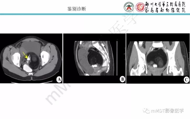 【PPT】卵巢肿瘤的影像诊断思路