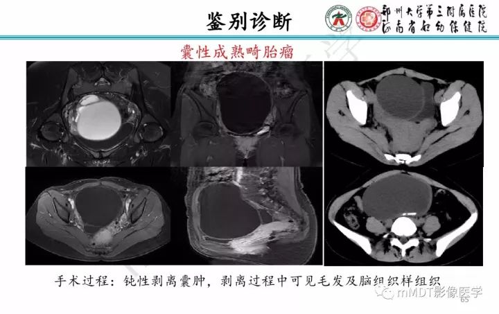 【PPT】卵巢肿瘤的影像诊断思路