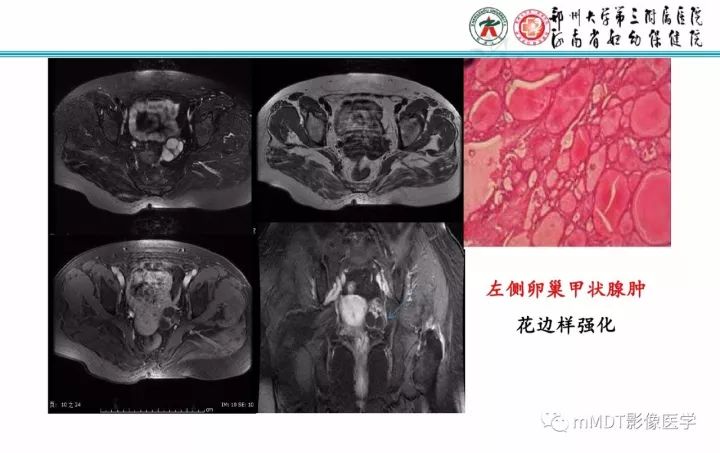【PPT】卵巢肿瘤的影像诊断思路