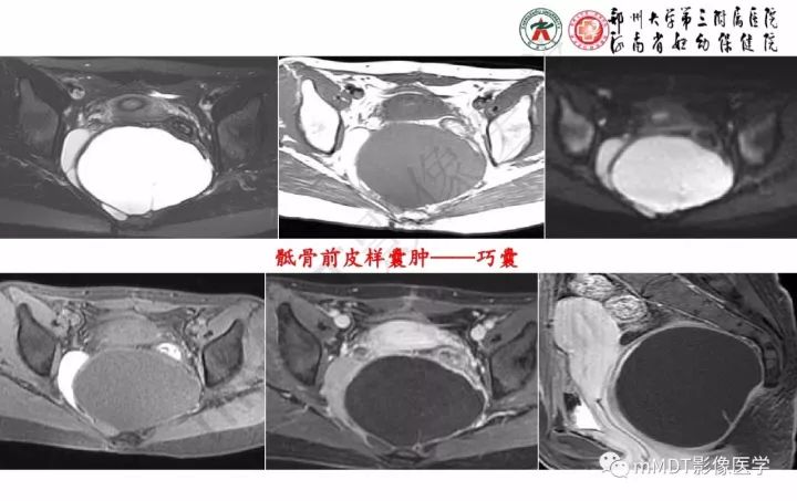 【PPT】卵巢肿瘤的影像诊断思路