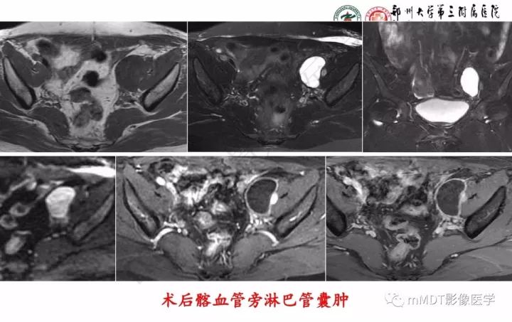 【PPT】卵巢肿瘤的影像诊断思路