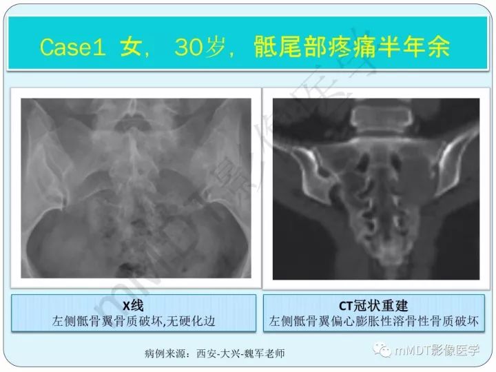 【PPT】骶骨骨巨细胞瘤影像诊断