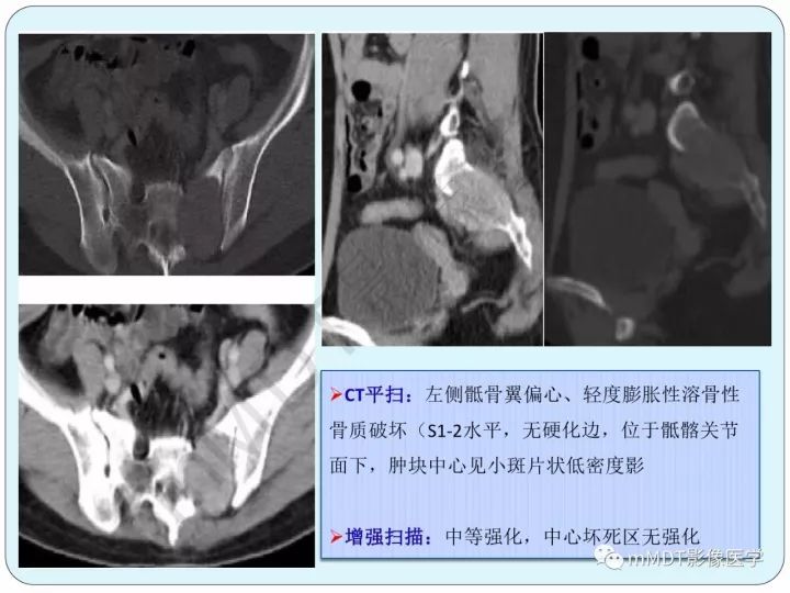 【PPT】骶骨骨巨细胞瘤影像诊断