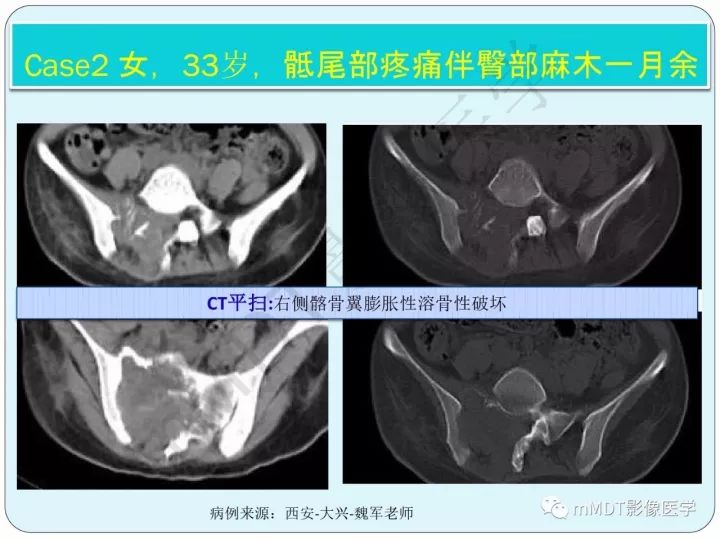 【PPT】骶骨骨巨细胞瘤影像诊断
