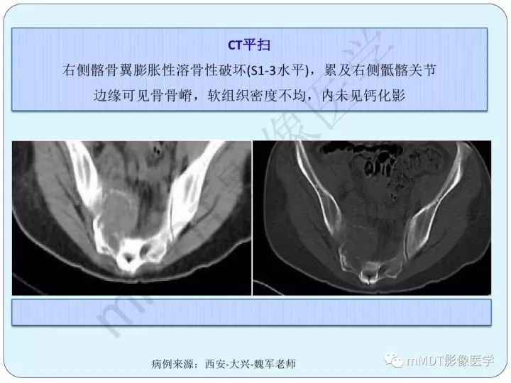 【PPT】骶骨骨巨细胞瘤影像诊断