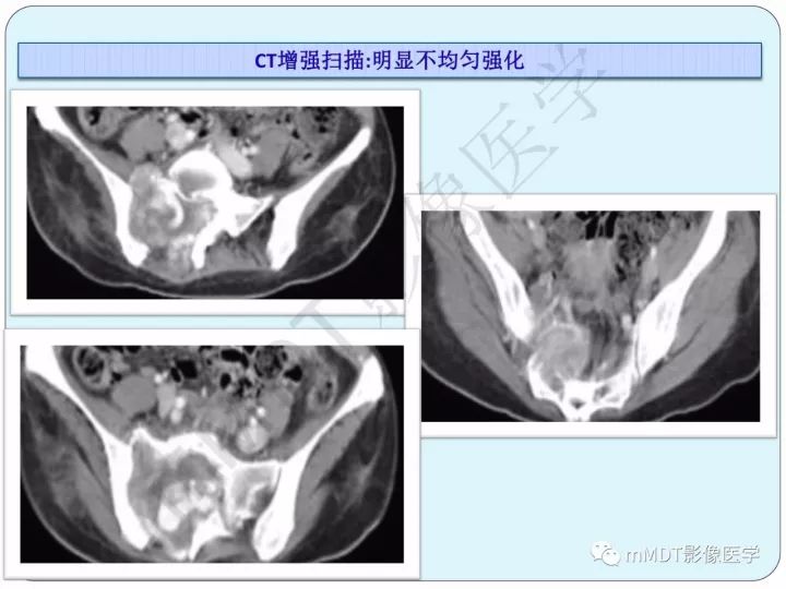 【PPT】骶骨骨巨细胞瘤影像诊断