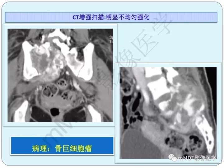 【PPT】骶骨骨巨细胞瘤影像诊断