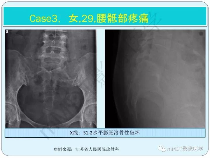 【PPT】骶骨骨巨细胞瘤影像诊断