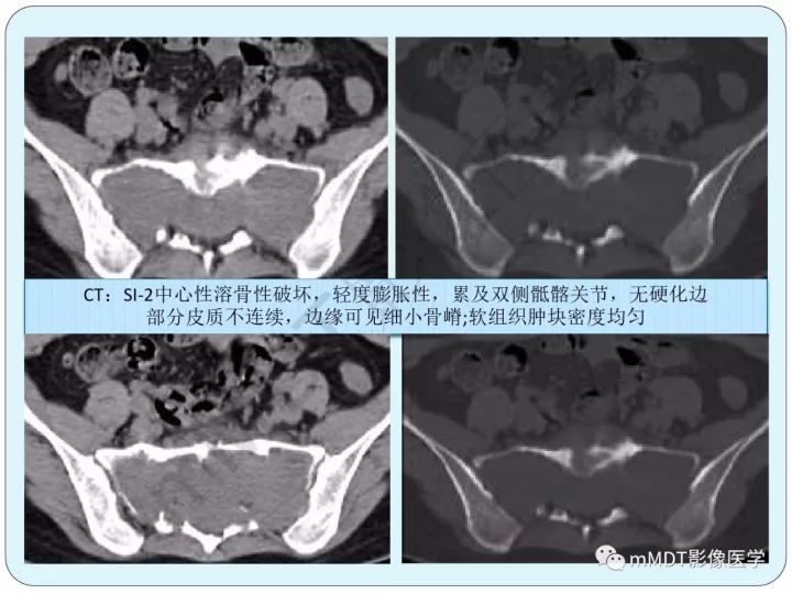 【PPT】骶骨骨巨细胞瘤影像诊断