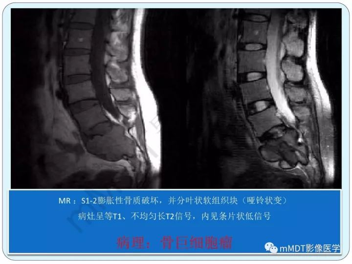 【PPT】骶骨骨巨细胞瘤影像诊断