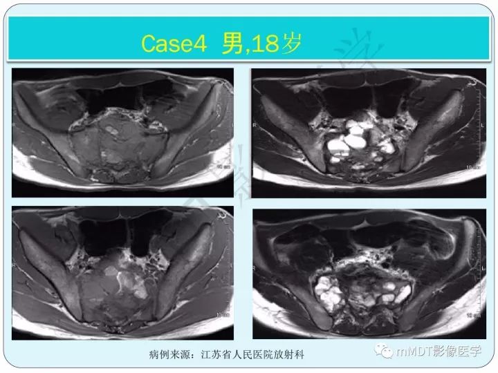 【PPT】骶骨骨巨细胞瘤影像诊断