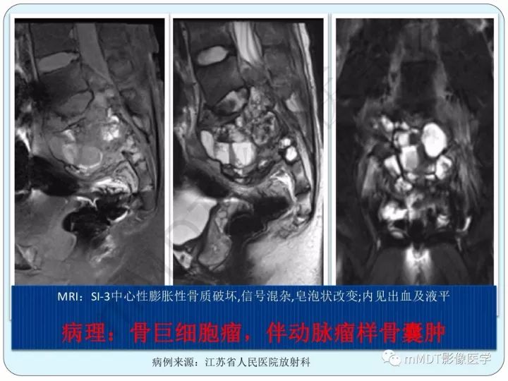 【PPT】骶骨骨巨细胞瘤影像诊断