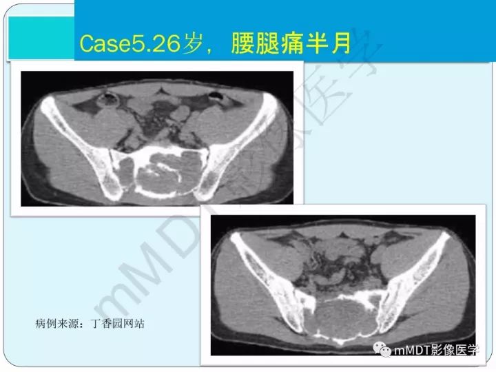 【PPT】骶骨骨巨细胞瘤影像诊断