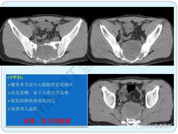 【PPT】骶骨骨巨细胞瘤影像诊断
