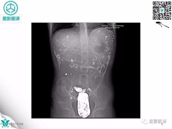 【病例】钡剂性腹膜炎1例X线CT