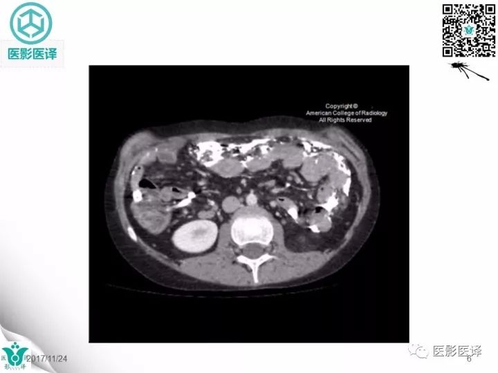 【病例】钡剂性腹膜炎1例X线CT