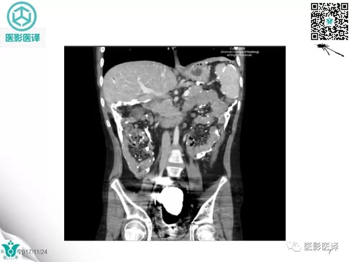 【病例】钡剂性腹膜炎1例X线CT