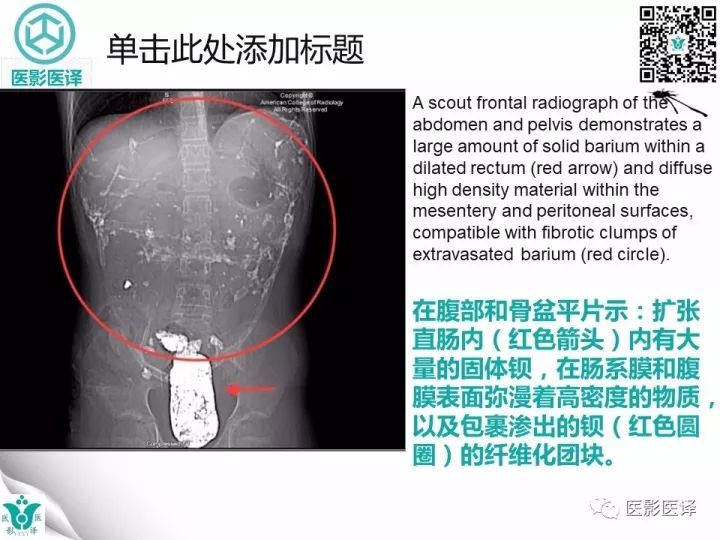 【病例】钡剂性腹膜炎1例X线CT