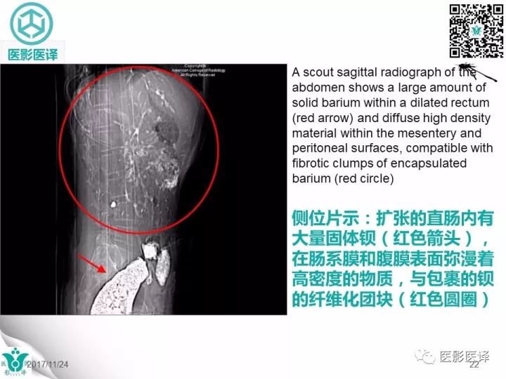 【病例】钡剂性腹膜炎1例X线CT
