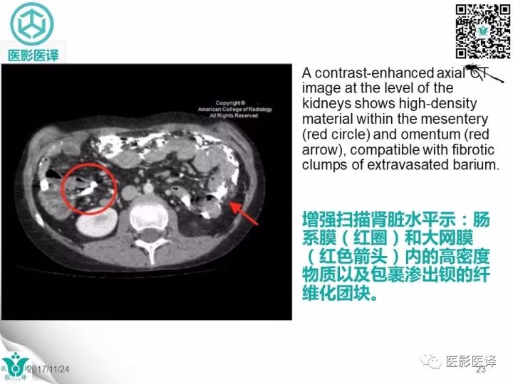 【病例】钡剂性腹膜炎1例X线CT