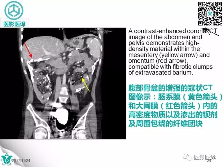 【病例】钡剂性腹膜炎1例X线CT