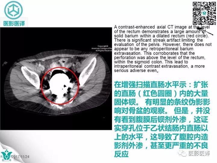 【病例】钡剂性腹膜炎1例X线CT
