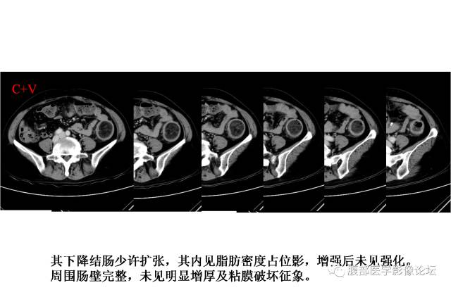 【病例】结肠脂肪瘤并肠套叠1例MR 【病例】结肠脂肪瘤并肠套叠1例MR