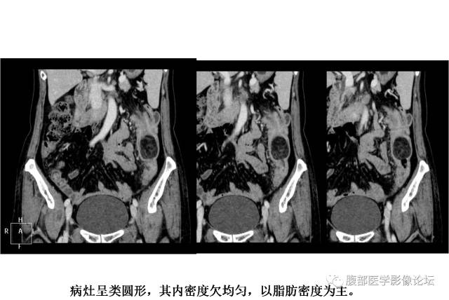 【病例】结肠脂肪瘤并肠套叠1例MR