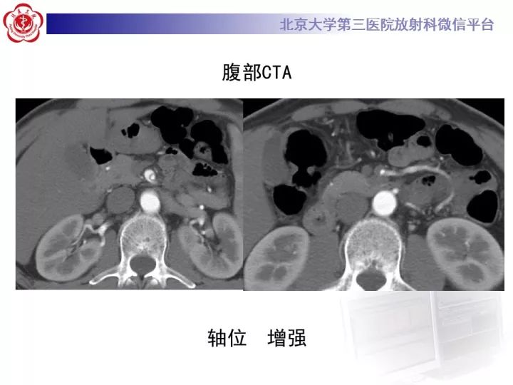 【病例】自发性肠系膜上动脉夹层1例CT