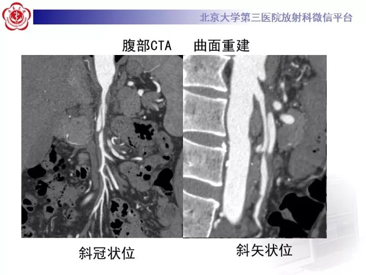 【病例】自发性肠系膜上动脉夹层1例CT