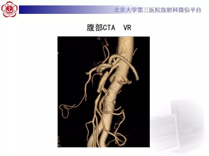 【病例】自发性肠系膜上动脉夹层1例CT