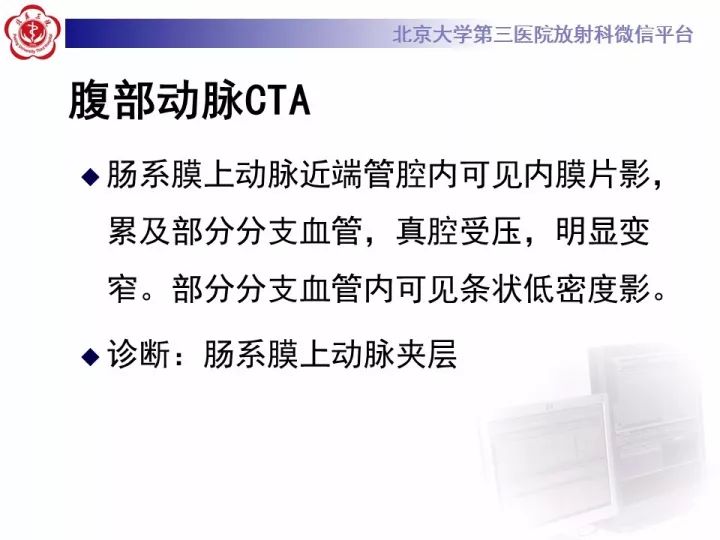 【病例】自发性肠系膜上动脉夹层1例CT