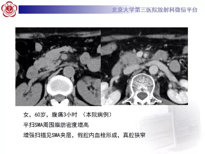 【病例】自发性肠系膜上动脉夹层1例CT
