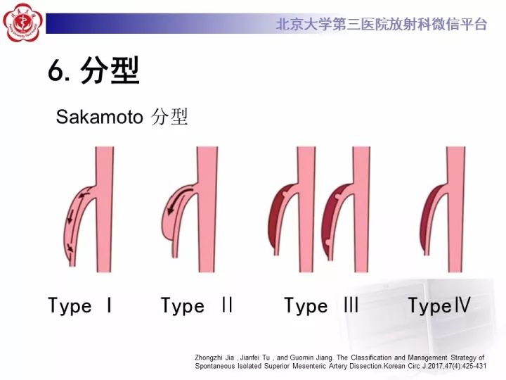 【病例】自发性肠系膜上动脉夹层1例CT
