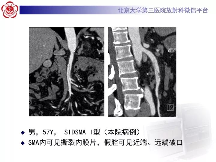 【病例】自发性肠系膜上动脉夹层1例CT