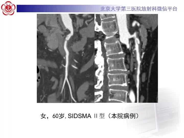 【病例】自发性肠系膜上动脉夹层1例CT