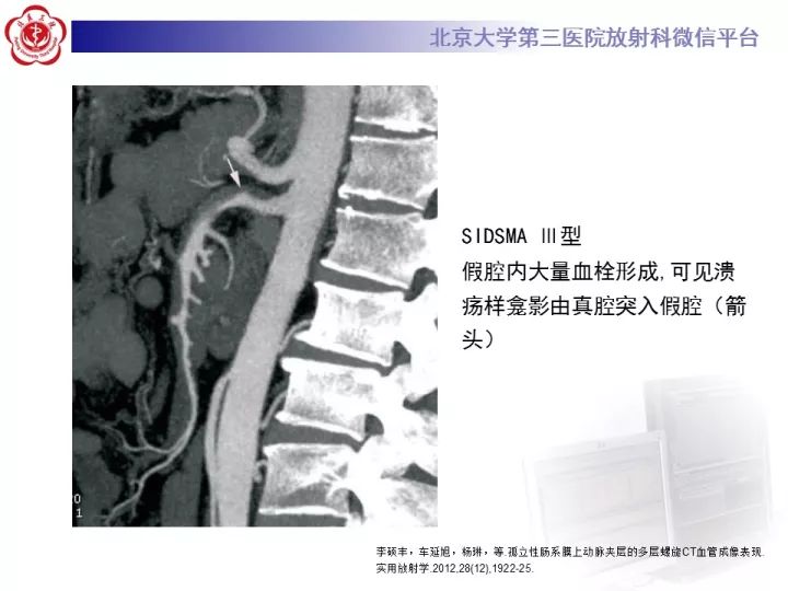 【病例】自发性肠系膜上动脉夹层1例CT