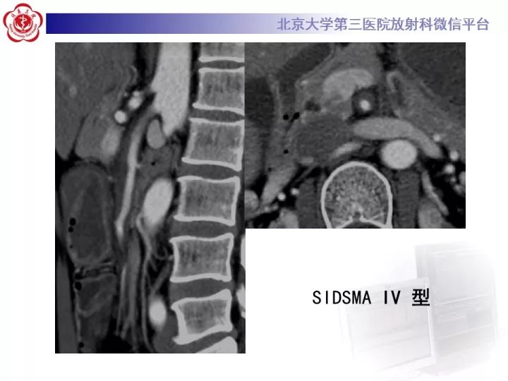 【病例】自发性肠系膜上动脉夹层1例CT