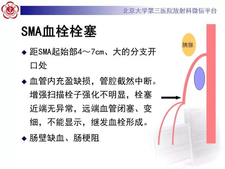 【病例】自发性肠系膜上动脉夹层1例CT