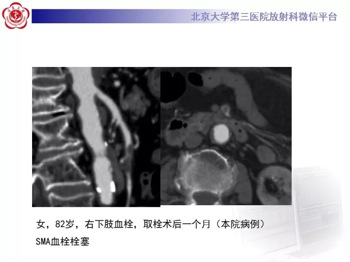 【病例】自发性肠系膜上动脉夹层1例CT