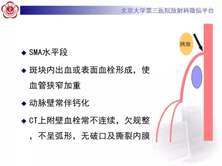 【病例】自发性肠系膜上动脉夹层1例CT