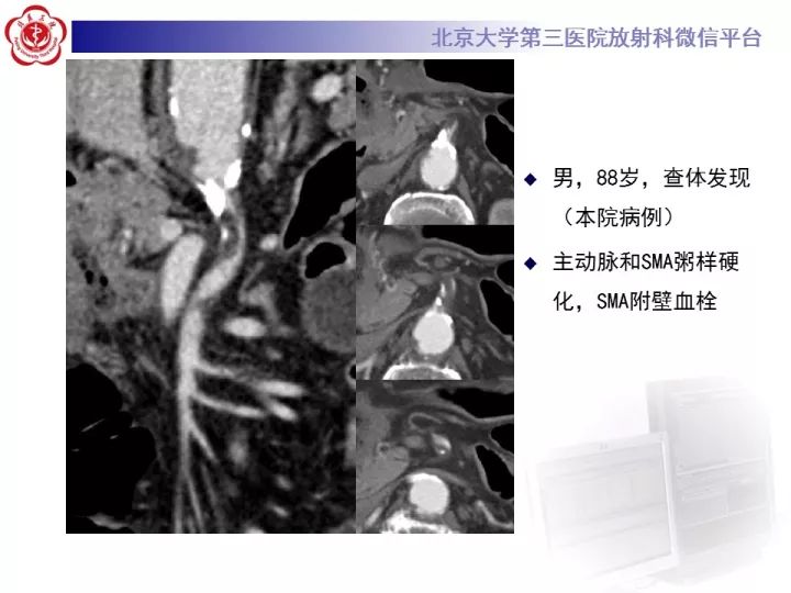 【病例】自发性肠系膜上动脉夹层1例CT