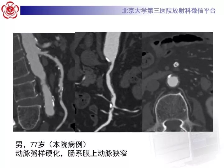 【病例】自发性肠系膜上动脉夹层1例CT