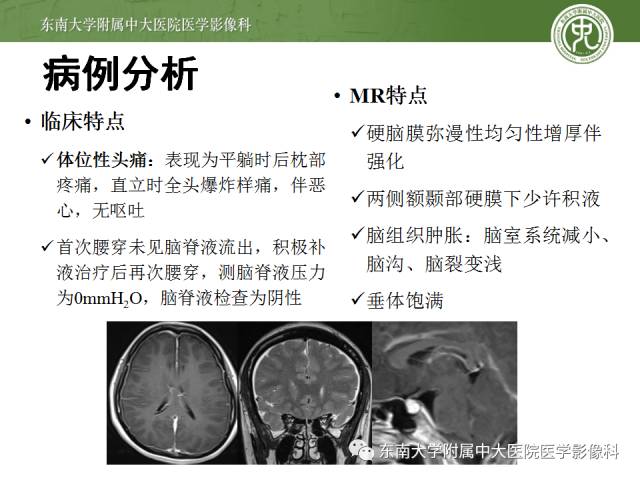 【病例】低颅压综合征1例MR影像表现